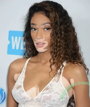 Winnie Harlow / winnieharlow nude photo #0528