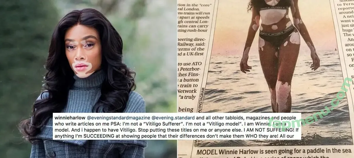 Winnie Harlow nude photo #0576 (winnieharlow)